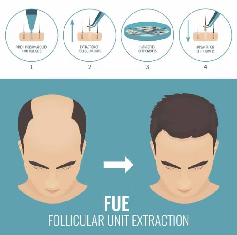 FUE Hair Implant Micro Motor H - огляд і ціна Hair Care Basic